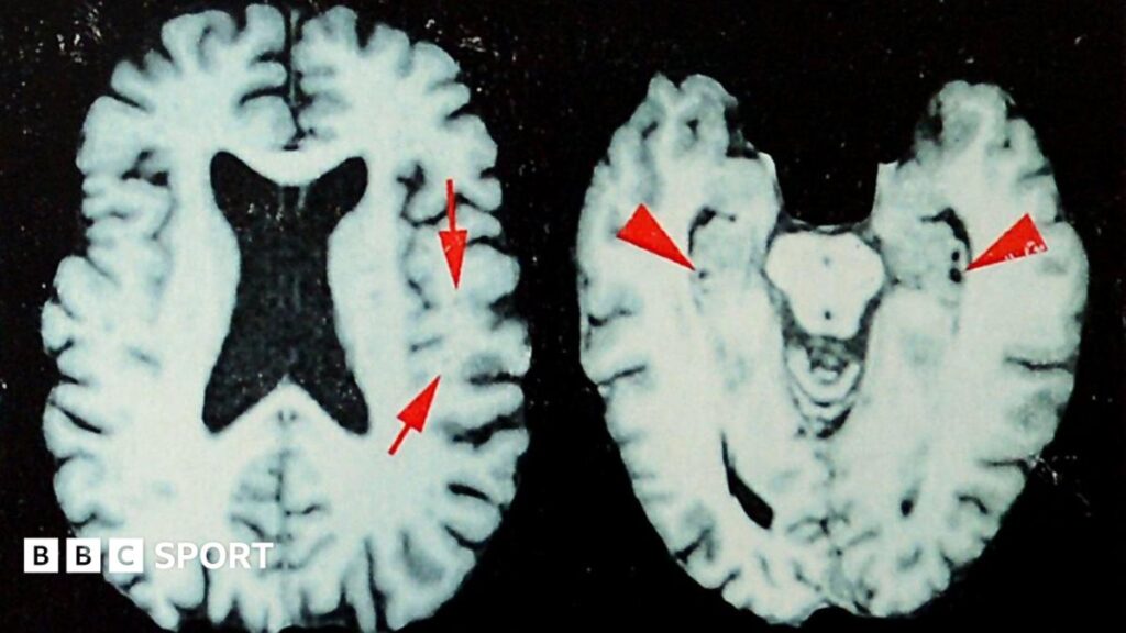 Study Finds 1 in 4 Former NFL Players (2016‑2021) Had Degenerative Brain Disease, Raising Global Sports Safety Concerns