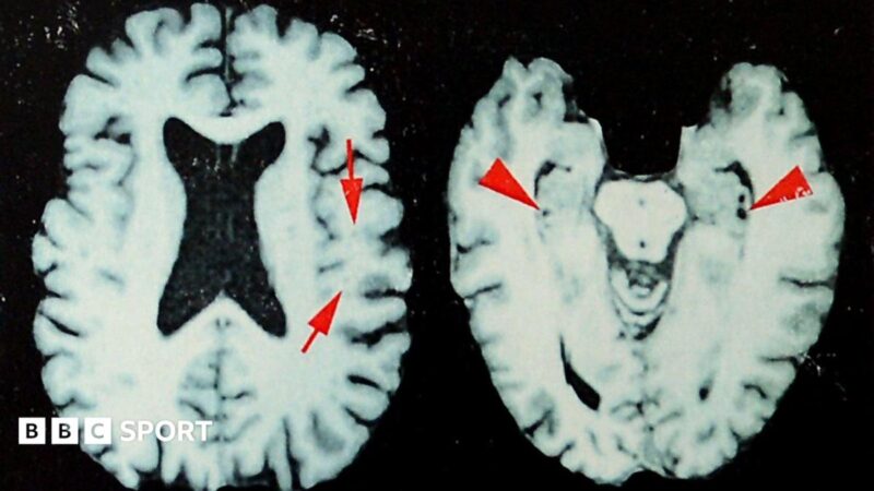 Study Finds 1 in 4 Former NFL Players (2016‑2021) Had Degenerative Brain Disease, Raising Global Sports Safety Concerns